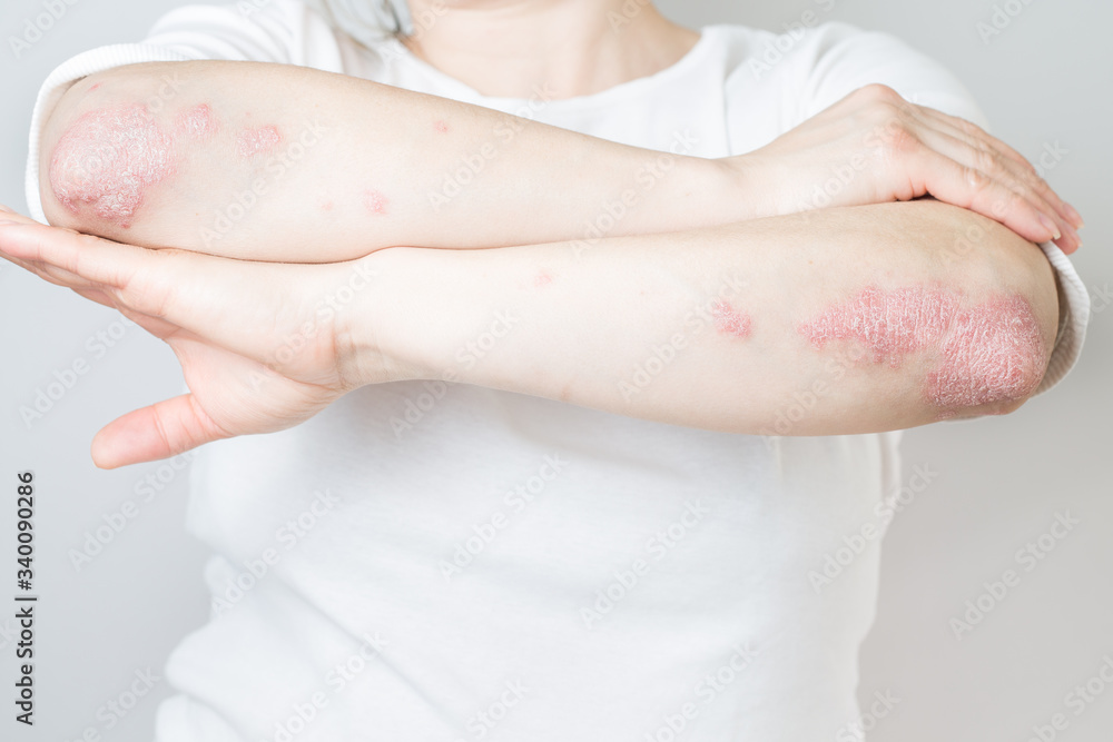 Acute psoriasis on elbows is an autoimmune incurable dermatological skin disease. Large red, inflamed, flaky rash on the knees. Joints affected by psoriatic arthritis. Acute psoriasis on elbows is an autoimmune incurable dermatological skin disease. Large red, inflamed, flaky rash on the knees. Joints affected by psoriatic arthritis.
