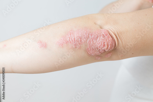 Acute psoriasis on elbows is an autoimmune incurable dermatological skin disease. Large red, inflamed, flaky rash on the knees. Joints affected by psoriatic arthritis.