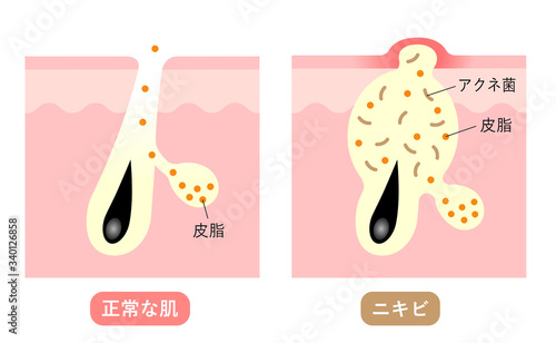 ニキビと正常な肌　毛穴の断面図