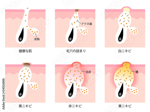 ニキビの症状と段階