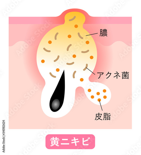 黄ニキビ　肌の断面図