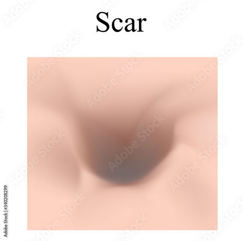 Atrophic scars. Acne scar. The anatomical structure of the skin with acne. Vector illustration on isolated background.