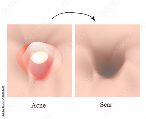 Atrophic scars. Acne scar. The anatomical structure of the skin with acne. Vector illustration on isolated background.