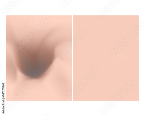 Texture with acne scars and acne. Before After scar cysts. Skin background. Infographics. Vector illustration