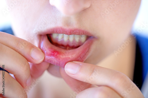 Red and painful canker sore photo