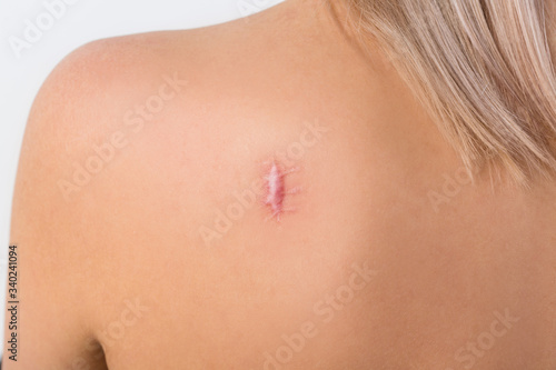 keloid scar on the back of a woman