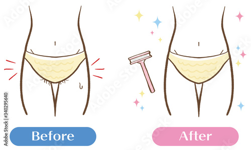 脱毛　Ｖライン　ムダ毛処理のイラストセット