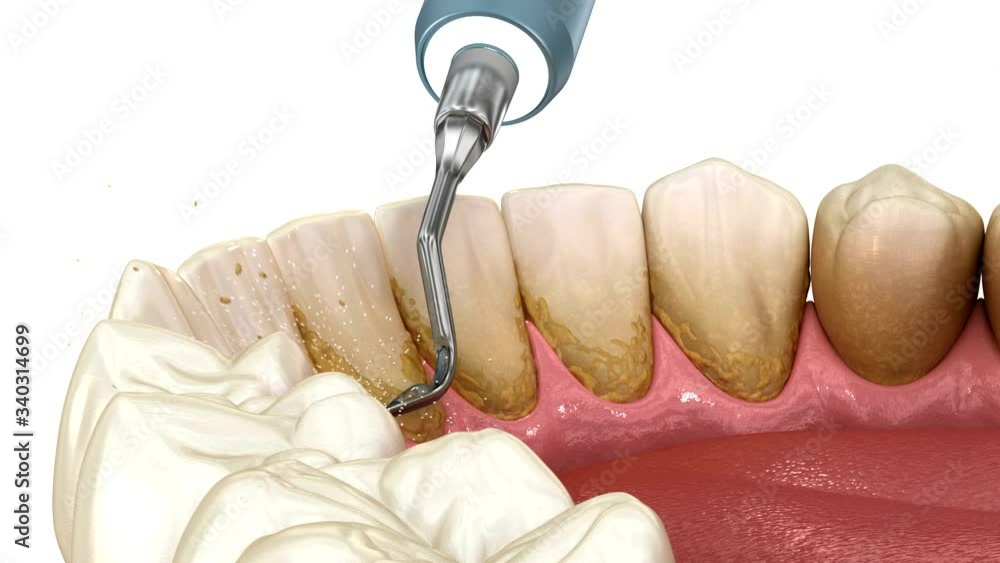Oral hygiene Teeth Cleaning Ultrasonic Scaling (conventional