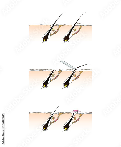 Hair growth after shave and depilation. Ingrown hair skin inflammation scheme. Hair follicle treatment illustration. Vector graphic illustration