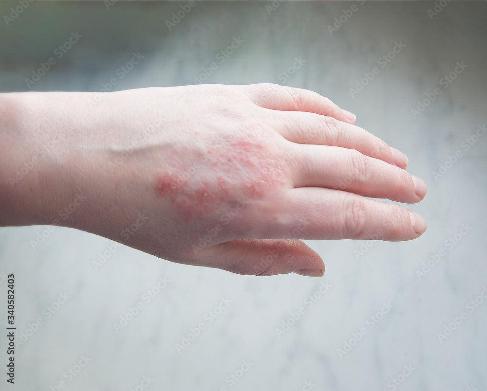 Fototapeta premium Skin irritation psoriasis