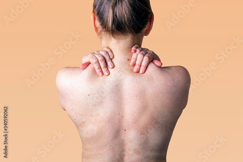 Allergic dermatitis on the skin of a woman's back. Skin disease. Neurodermatitis disease, eczema or allergy rash. Healthcare and Medical. photo