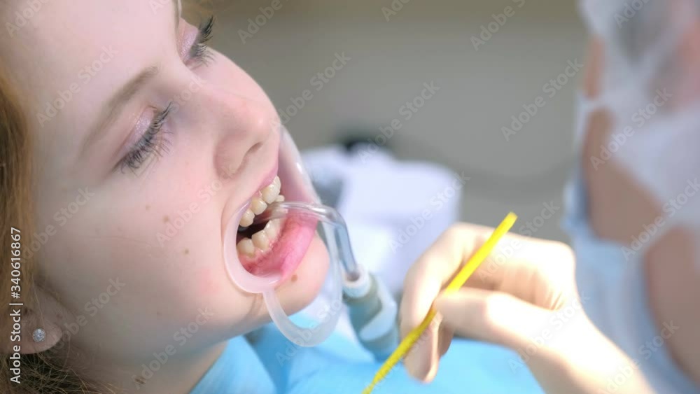 Orthodontist preparing woman teeth in dentistry before braces installing covering special gel using brush. Treatment and cure in dentistry. Portrait of girl with retractor in mouth, side view. Orthodontist preparing woman teeth in dentistry before braces installing covering special gel using brush. Treatment and cure in dentistry. Portrait of girl with retractor in mouth, side view.