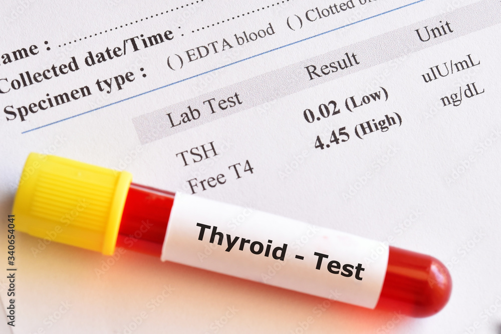 Obraz premium Blood sample tube with abnormal thyroid hormone test result