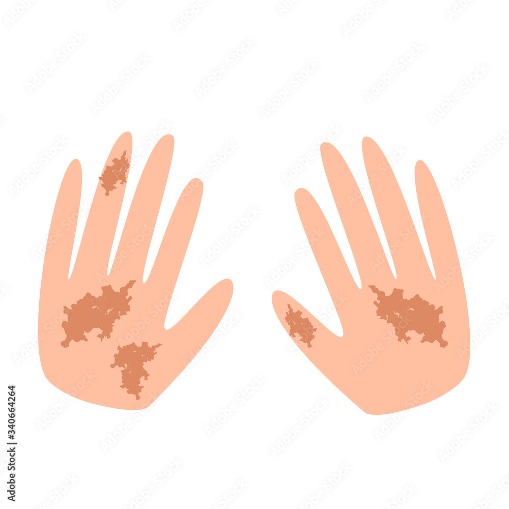 Freckles on the hands. Pigmentation on the skin. A pigmented spot on the skin of the hands. Vector illustration Freckles on the hands. Pigmentation on the skin. A pigmented spot on the skin of the hands. Vector illustration