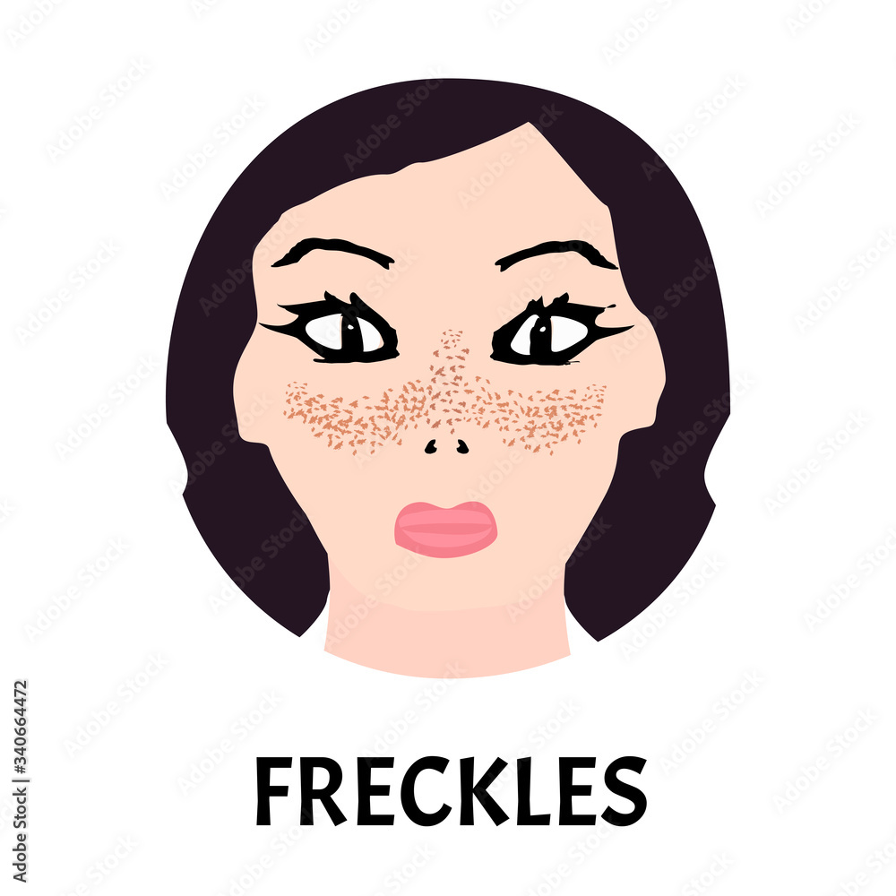 Freckles on the face. Pigmentation on the skin. A pigmented spot on the skin of the face. Before