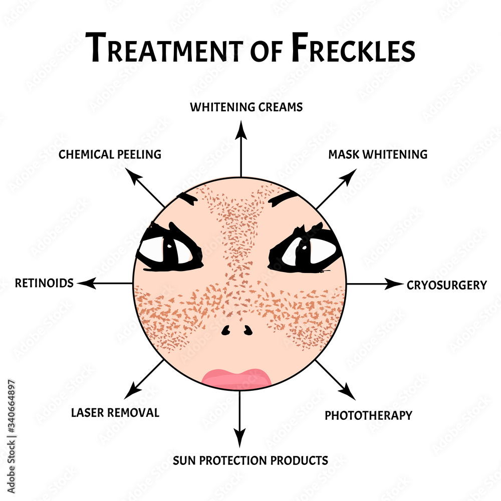 Fototapeta premium Freckles on the face. Pigmentation on the skin. A pigmented spot on the skin of the face. treatment. Vector illustration