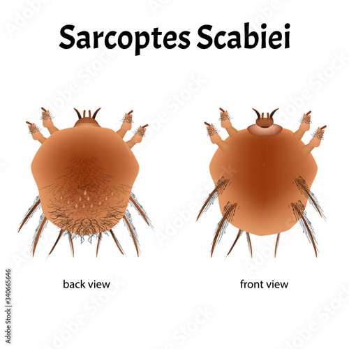 Sarcoptes scabiei. scabies. Sexually transmitted disease. Infographics. illustration on isolated background.