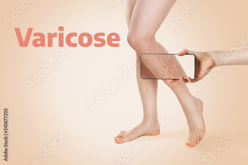 Tableau sur toile Woman's beautiful legs with varicose veins on the lower leg, which was determined using online diagnostics on the smartphone app