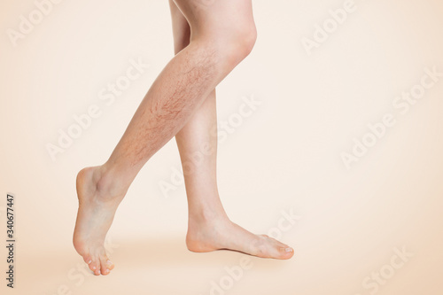 Obraz na plátně Smooth female legs, with varicose veins and swelling on the lower leg