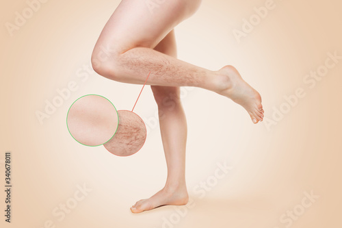 Female smooth beautiful legs, with varicose veins on the lower leg. Zoomed image of varicose veins, Before and after treatment. Beige background. A copy of the space.The concept of varicose disease photo
