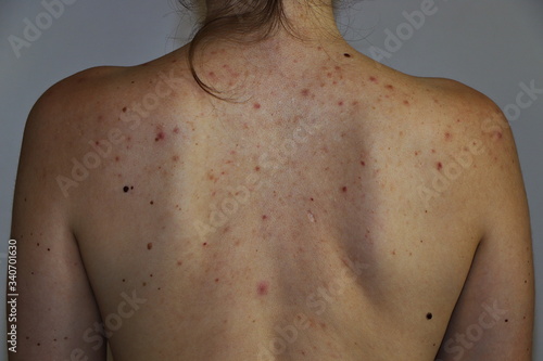 Close up of young European woman with acne and red spots on the back, isolate on grey background, Healthy skin concepts.