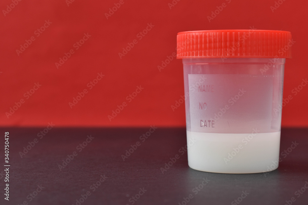 Sperm donation. A sperm sample. Infertility. A jar of analysis. Stock