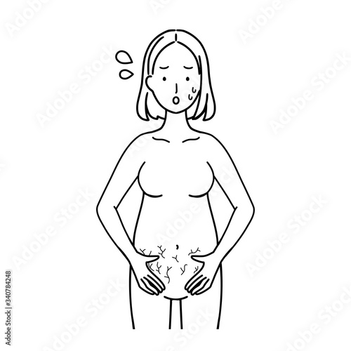 Illustration of a pregnant woman who is shocked by stretch marks.
