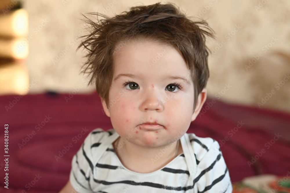 herpes in a child. the child has sprinkled her face with herpes herpes in a child. the child has sprinkled her face with herpes