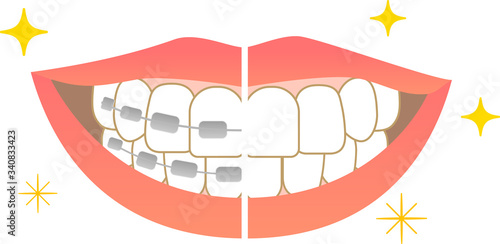 Tooth alignment Dental care Before orthodontic treatment After treatment