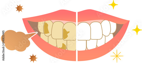 Bad breath from the mouth and whitening