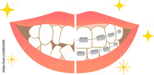 Tooth alignment Dental care Before orthodontic treatment After treatment