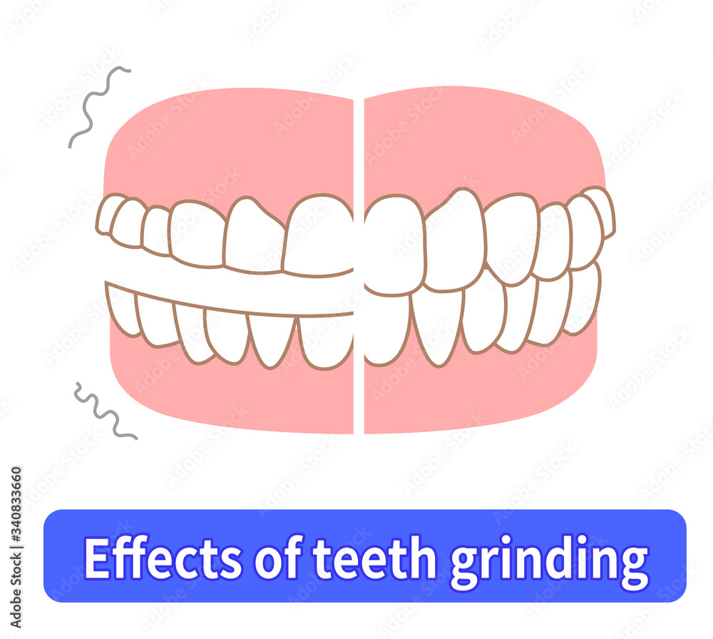 Teeth wear and TCH stress temporomandibular disorders Teeth wear and TCH stress temporomandibular disorders
