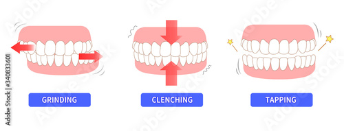 Teeth wear and TCH stress temporomandibular disorders