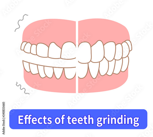 Teeth wear and TCH stress temporomandibular disorders