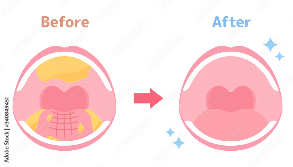 口腔ケアのイラスト ビフォーアフター Stock Vector Adobe Stock 口腔ケアのイラスト ビフォーアフター Stock Vector Adobe Stock