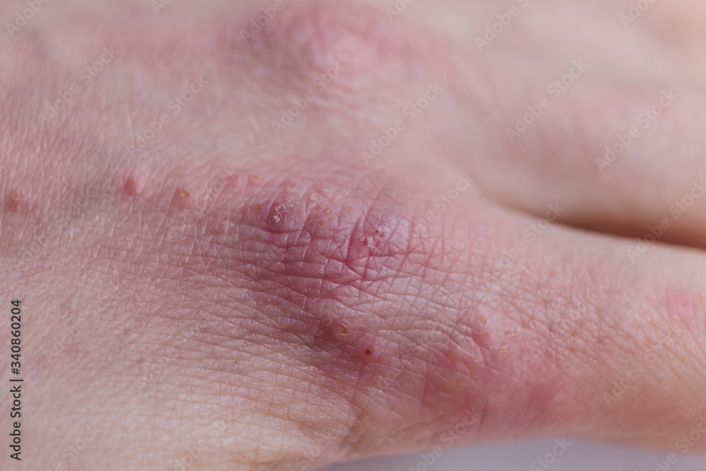 close-up of a patients fingers showing plaques of dry skin typically seen with psoriasis close-up of a patients fingers showing plaques of dry skin typically seen with psoriasis