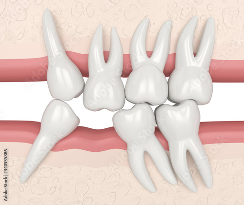 3d render of teeth sliding towards the area of missing tooth in order to fill the gap