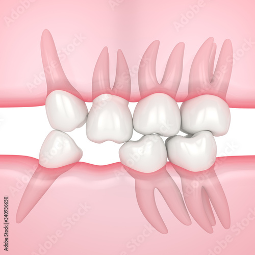 3d render of teeth sliding towards the area of missing tooth in order to fill the gap © Aleksandra Gigowska