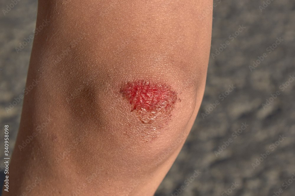 bruised wound on the knee, the boy fell and scratched his knee bruised wound on the knee, the boy fell and scratched his knee