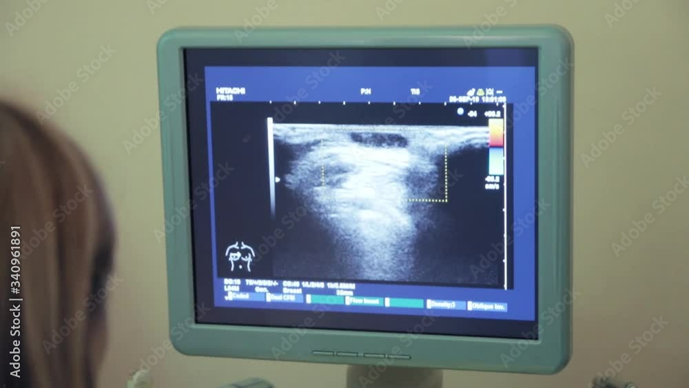 Patient's kidney on the monitor Patient's kidney on the monitor