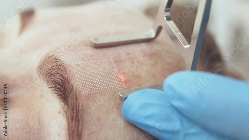 laser face cleaning CO2 close-up