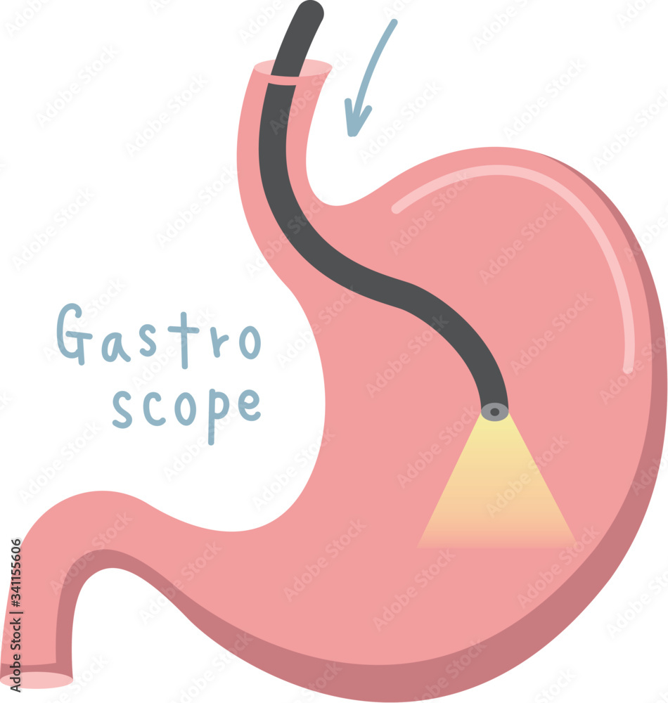 胃のイラスト 胃カメラ Stock Vector Adobe Stock 胃のイラスト 胃カメラ Stock Vector Adobe Stock