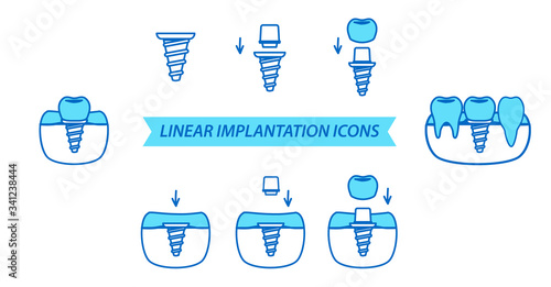 Dental Icons Set. Linear implantation icons. Line style. Vector illustration