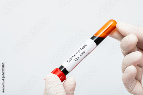 Coronavirus 2019-nCoV Blood Sample. blood for corona, covid-19 virus examination, collected to do a battery of laboratory tests.
