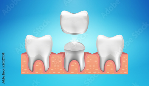 Dental Crown Restoration in realistic style. Medically accurate. Vector illustration 
