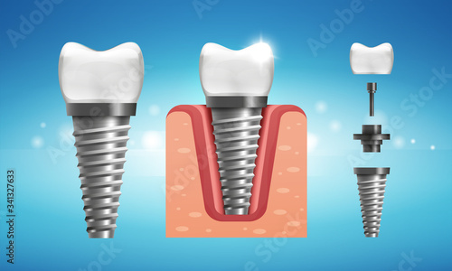 Dental implant structure in realistic style.Human teeth with gum.  Medically accurate. Vector illustration