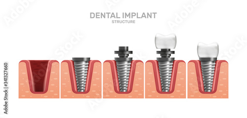 Dental implant structure and full placement steps in realistic style. Сrown, abutment, screw. Gingiva. Stomatology dentistry. Vector 3d illustration.