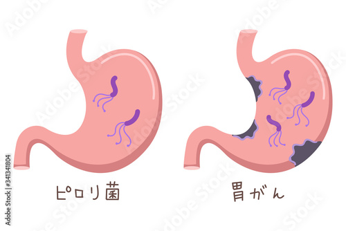 胃の中の菌のイラスト（ピロリ菌・胃がん）