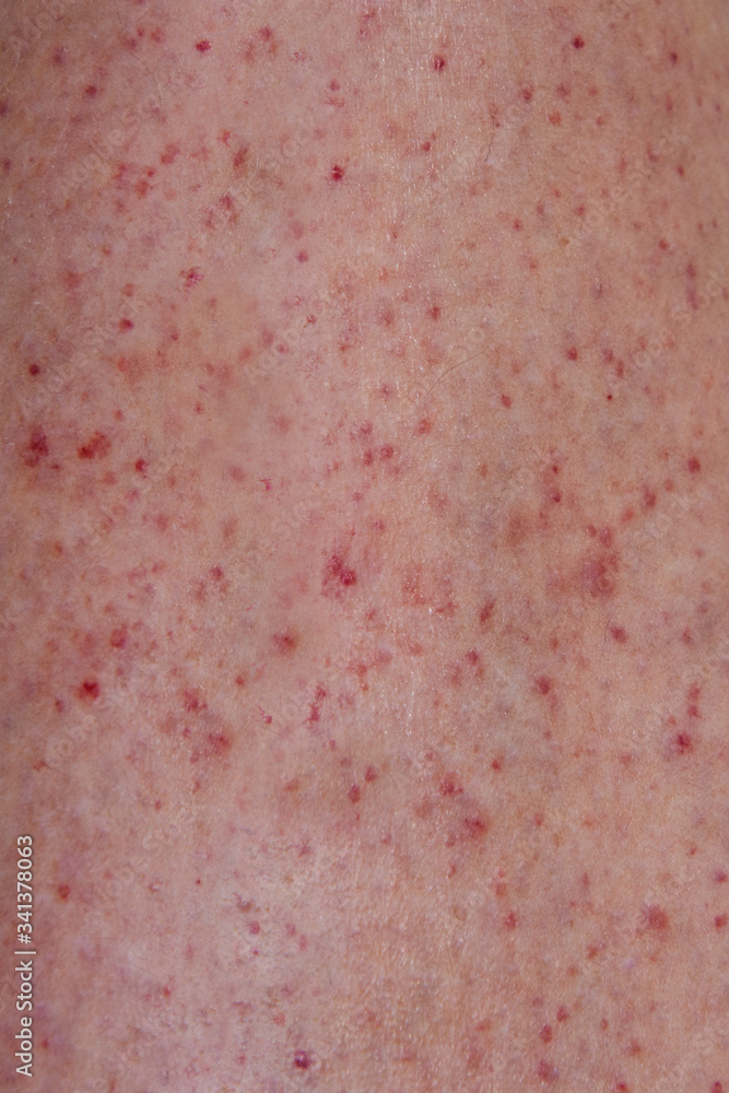 Close up of petechiae rash on a leg Stock Photo Adobe Stock