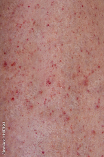 Fotografie Close up of petechiae rash on a leg